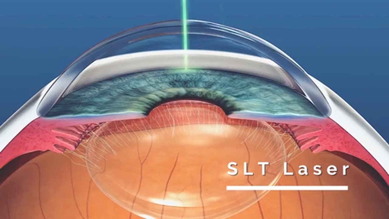 Glaucoma Surgery Trabeculectomy